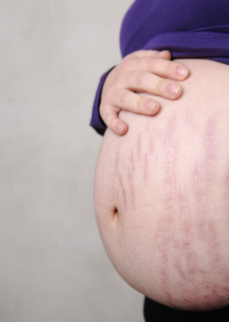 Những vấn đề về da khi mang thai