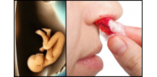 Cách sơ cứu cho mẹ bầu khi chảy máu cam an toàn và hiệu quả, mẹ nên lưu lại khi cần